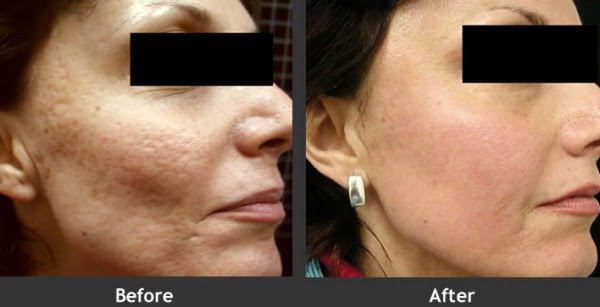 cicatrici acne