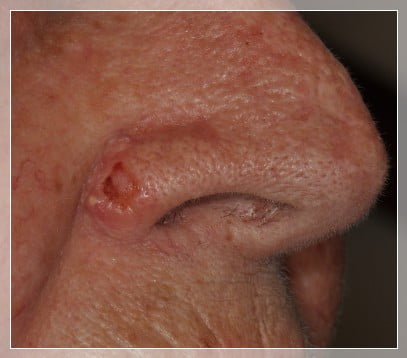 Carcinoma-basocellulare ulcerato