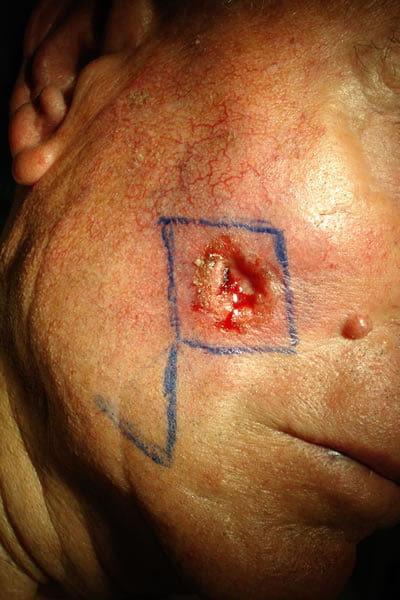 carcinoma basocellulare ulcerato