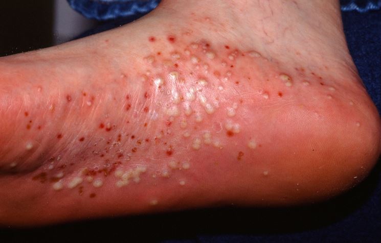 psoriasi-pustolosa
