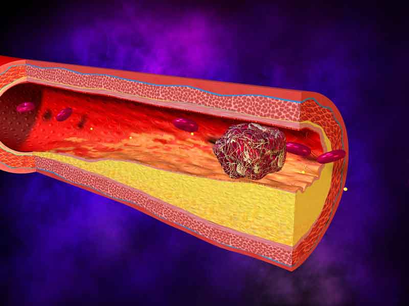 Trombosi, patologia con grumi nei vasi sanguigni Trombosi, patologia con grumi nei vasi sanguigni