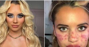 Influencer si tatua da sola lentiggini con ago e inchiostro. Rischia di perdere la vista:
